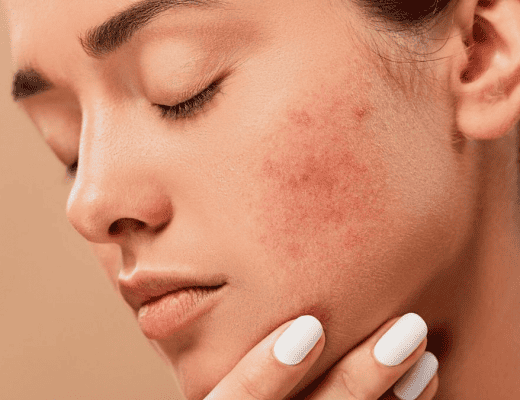 remèdes naturels contre l'acné